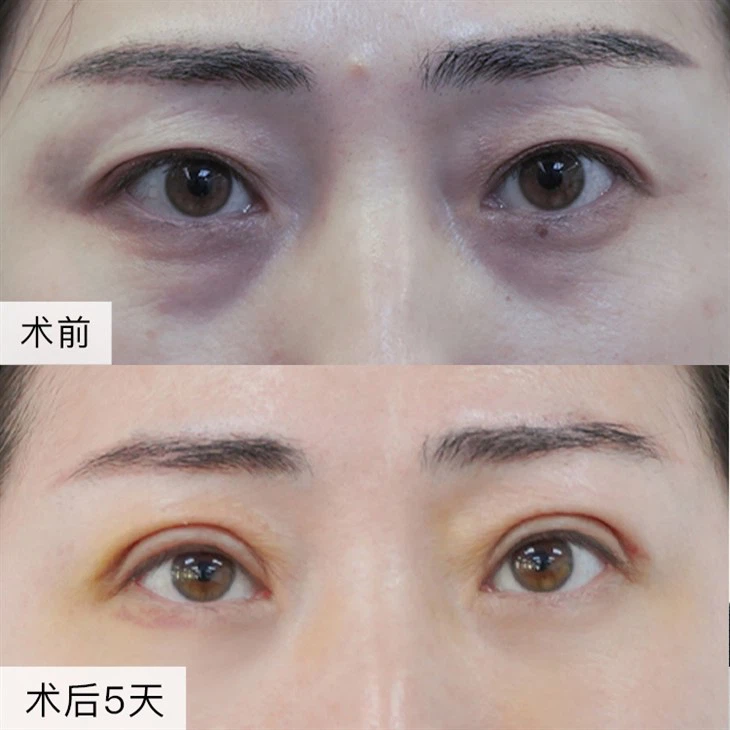 2Risks of Double Eyelid Repair